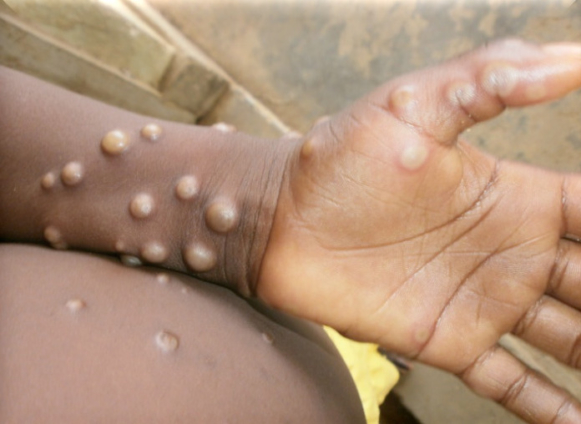 5 cases of monkeypox confirmed in Ghana