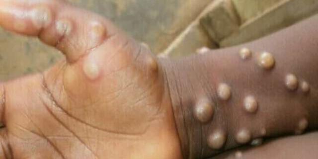 Monkeypox: Deceased in Bolgatanga was a soldier – Health Directorate